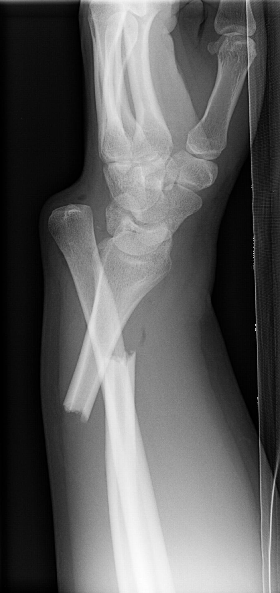 Fraktur Unterarm