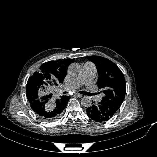 CT Thorax Weichteilfenster transversal