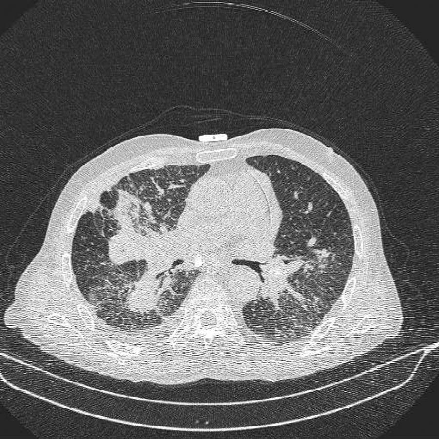 CT Thorax Lungenfenster