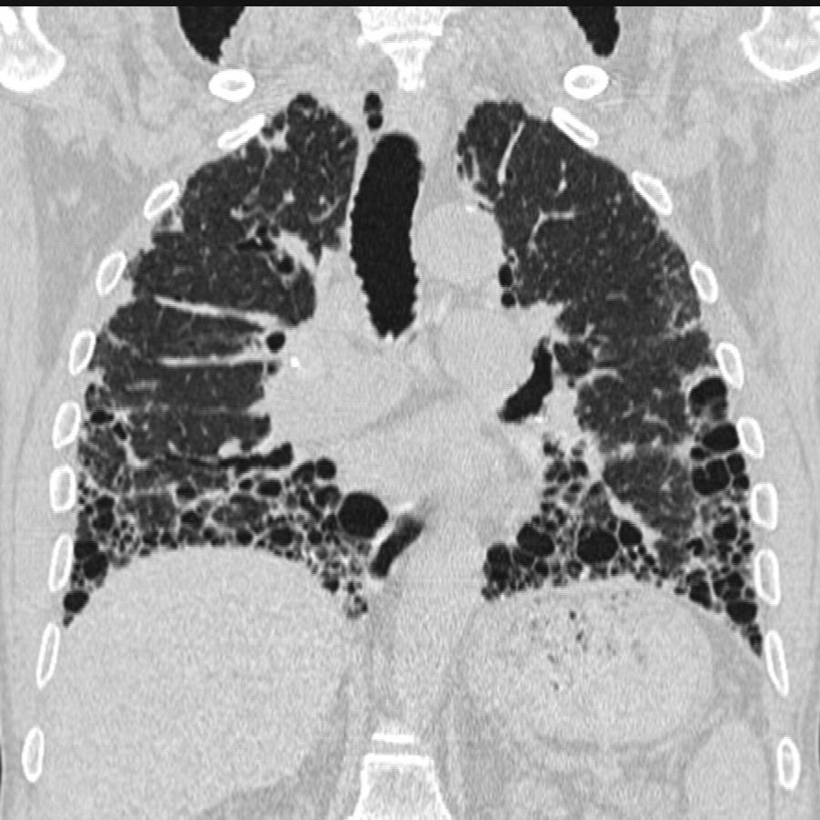 CT Thorax Lungenfenster koronar