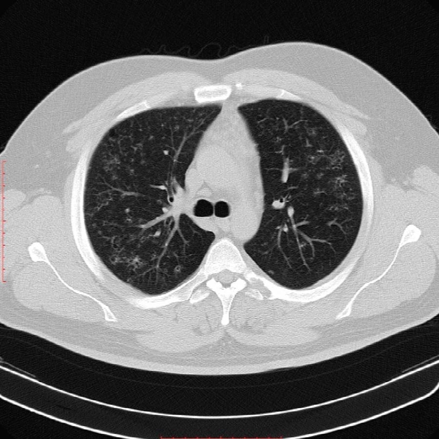 CT Thorax Lungenfenster transversal