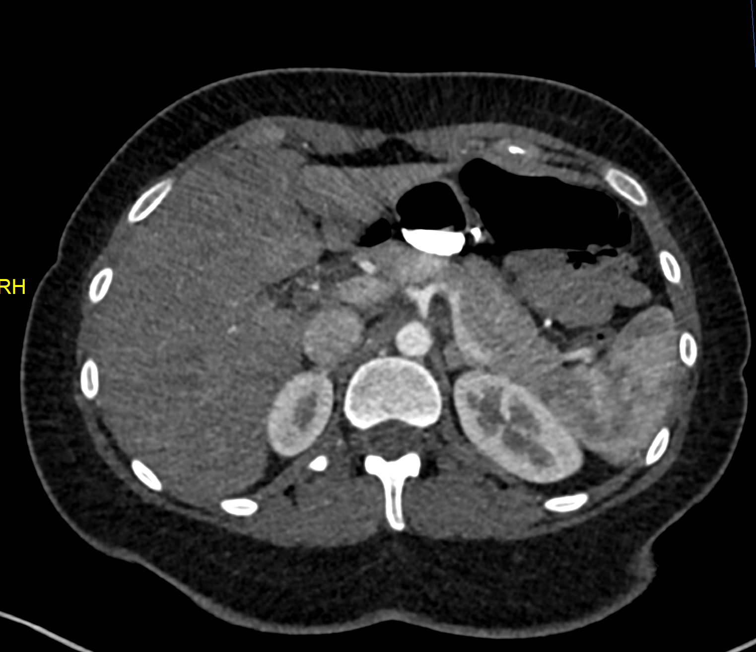 CT axial 