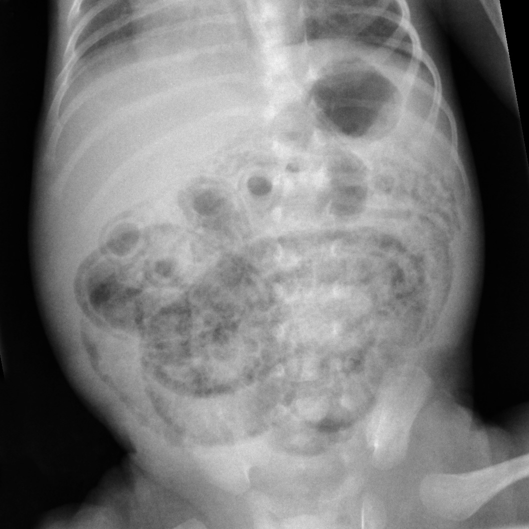 Röntgen Abdomen a.p.