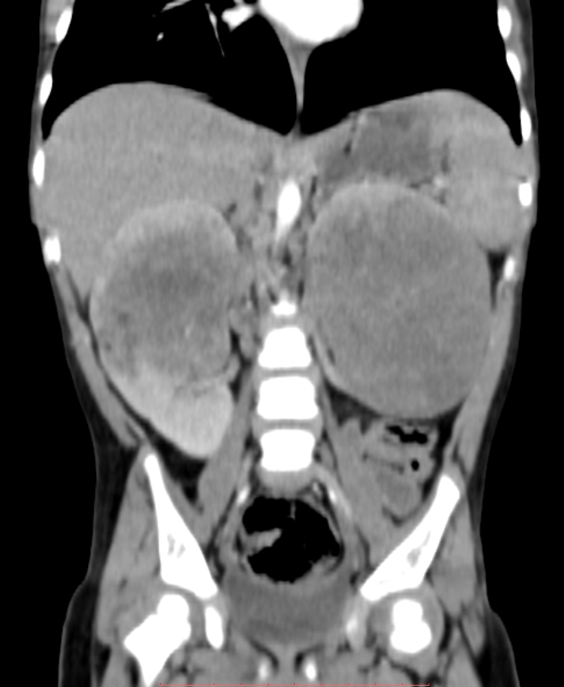 Nephroblastom bilateral