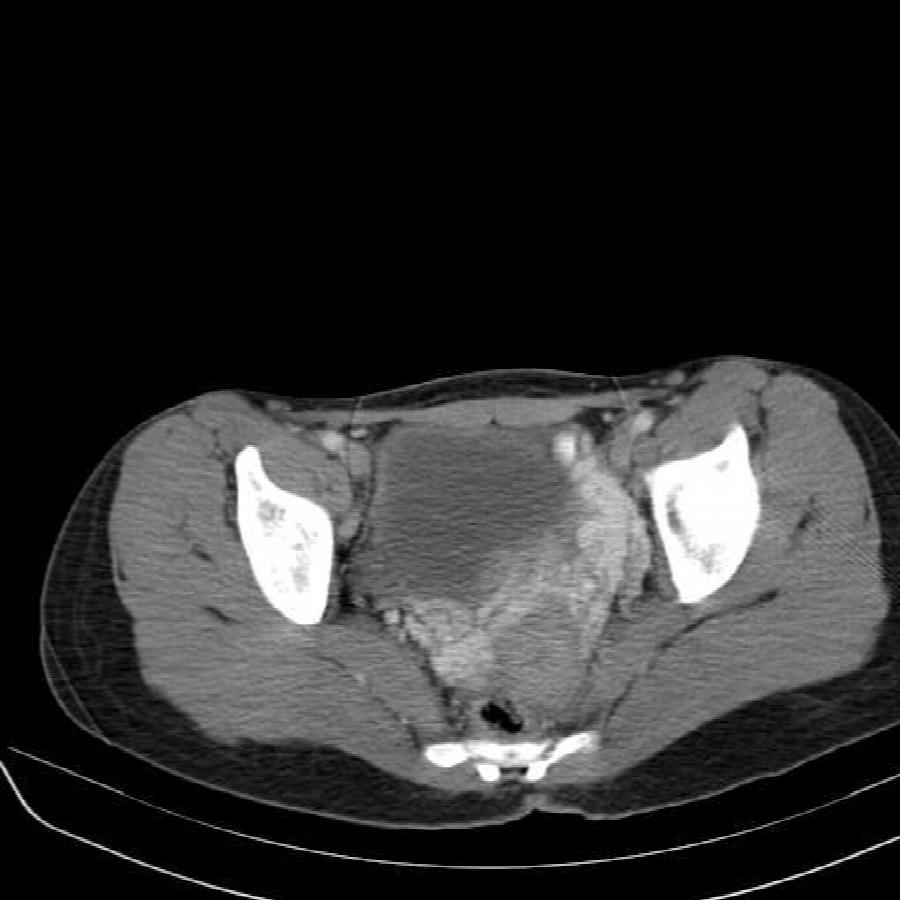 Axiale CT des Beckens