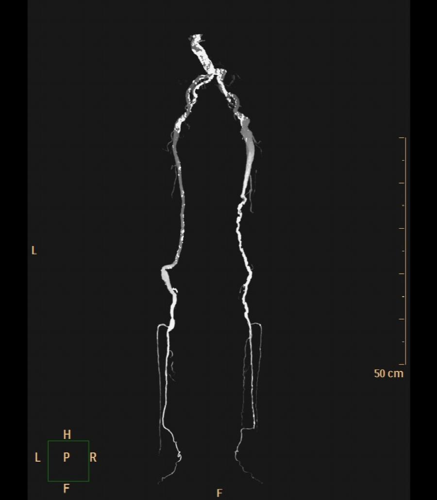 kontrastmittelgestützte MIP-Rekonstruktion einer CT-Angiographie