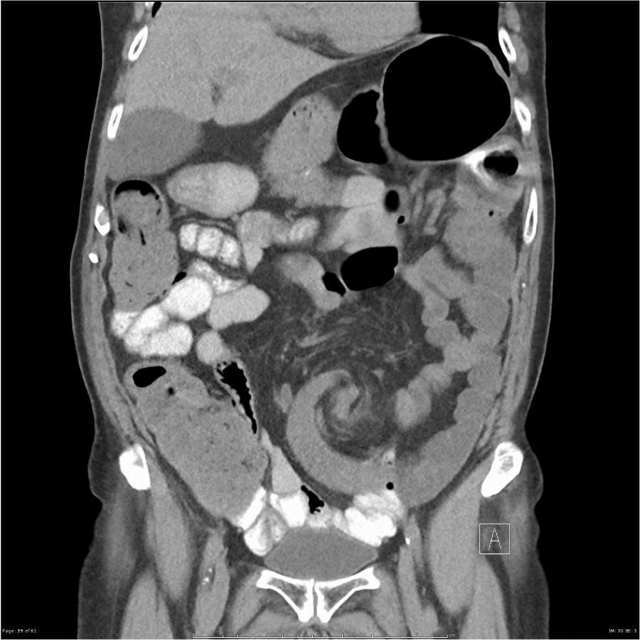 CT Abdomen coronar portalvenöse Phase