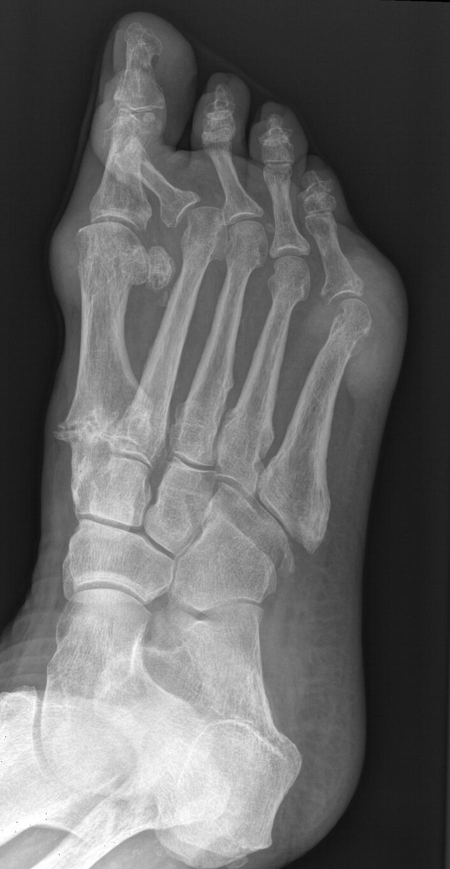 Röntgen Fuß seitlich