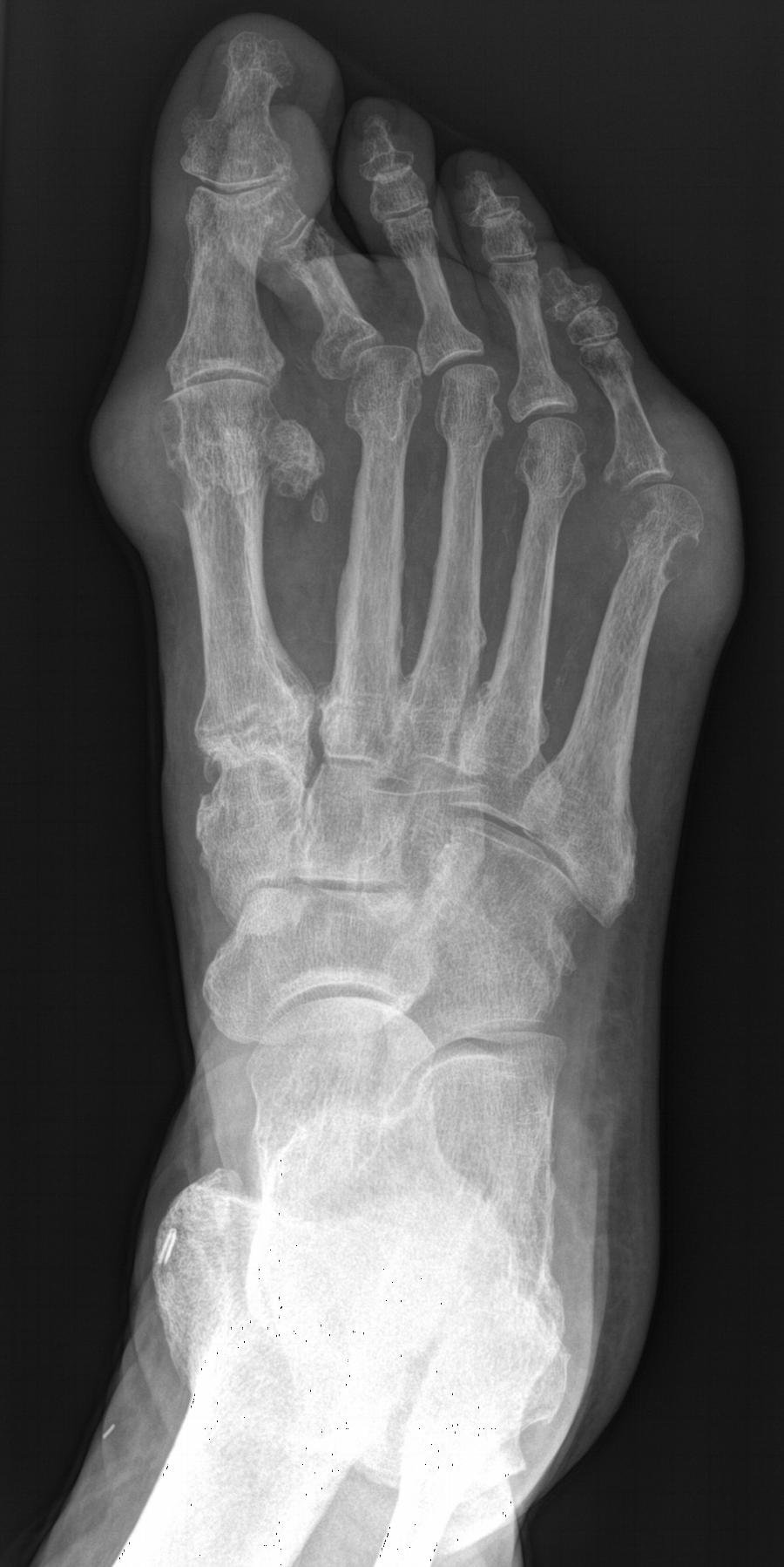 Röntgen Fuß ap