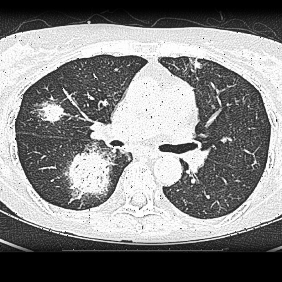 CT Thorax axial