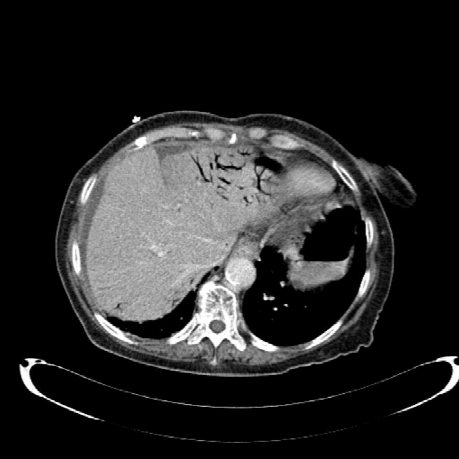 CT Abdomen transversal portalvenöse Phase