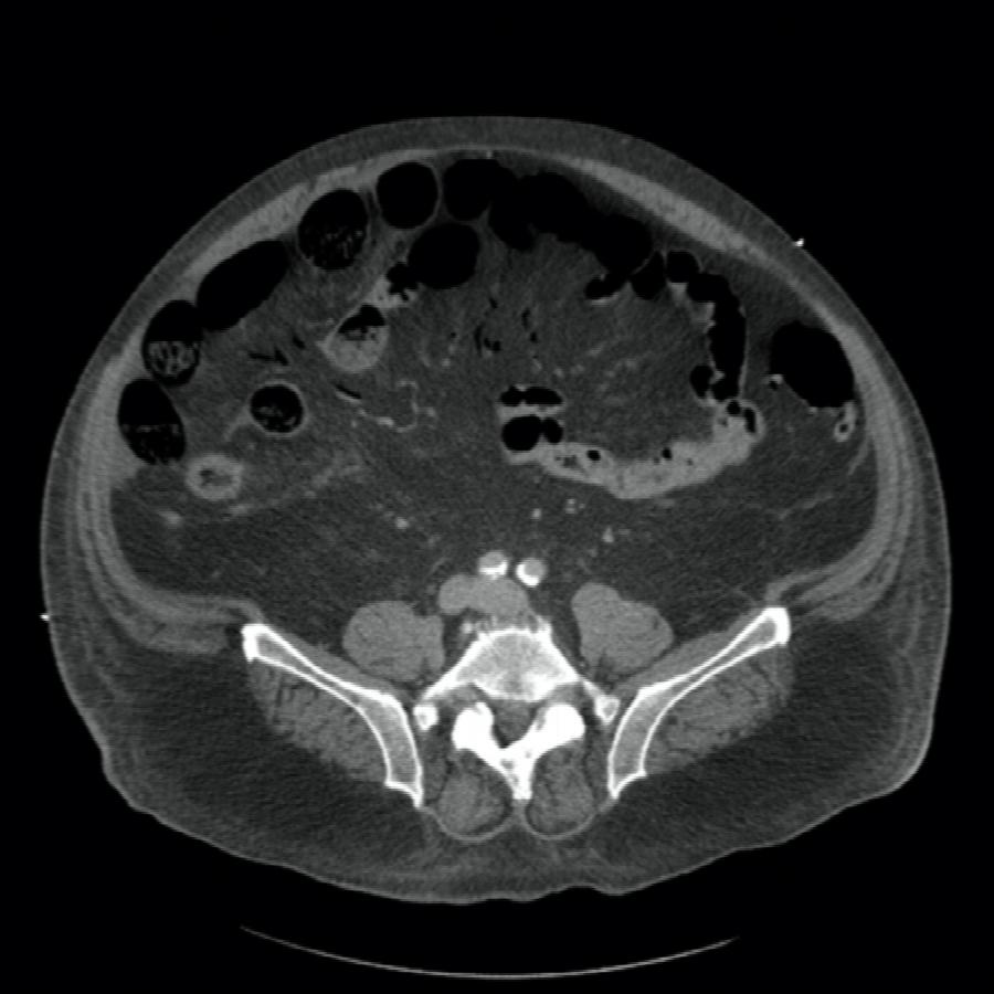 CT Abdomen trasnversal portalvenöse Phase