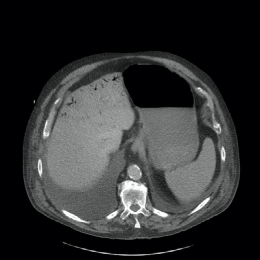 CT Abdomen trasnversal portalvenöse Phase
