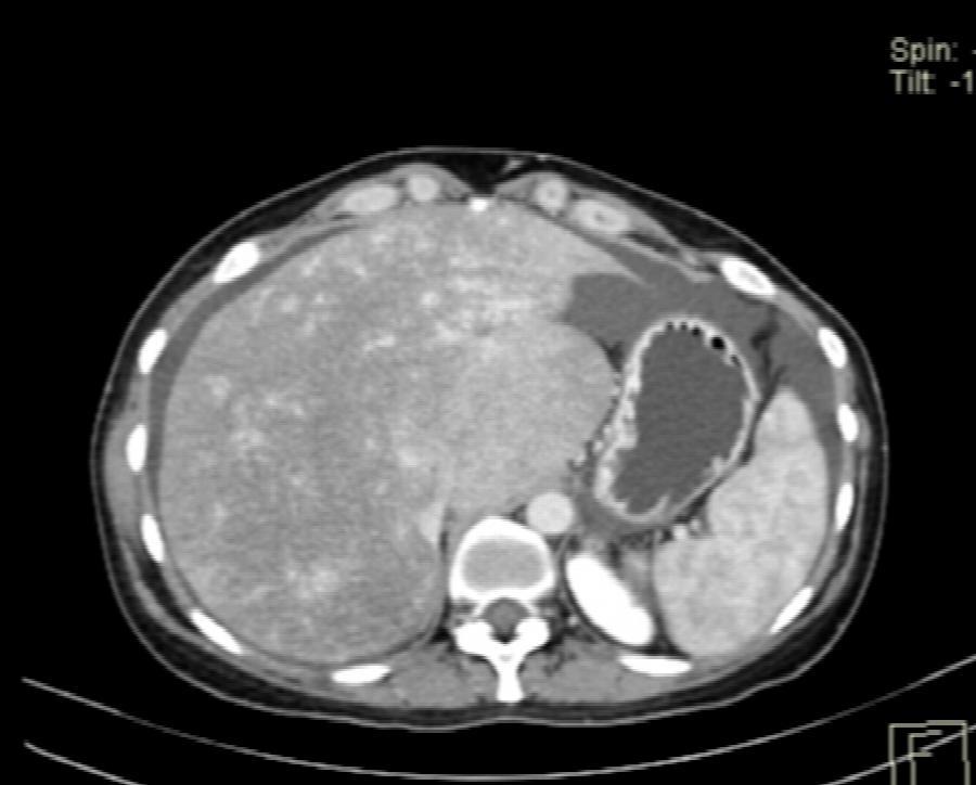 CT Abdomen transversal portalvenöse Phase