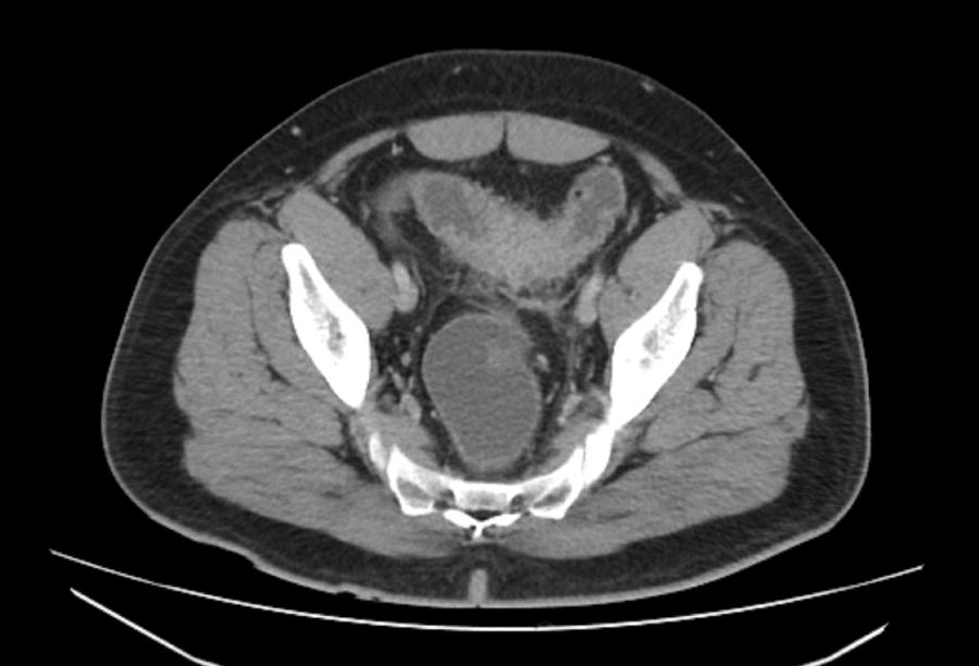 CT Abdomen transversal portalvenöse Phase