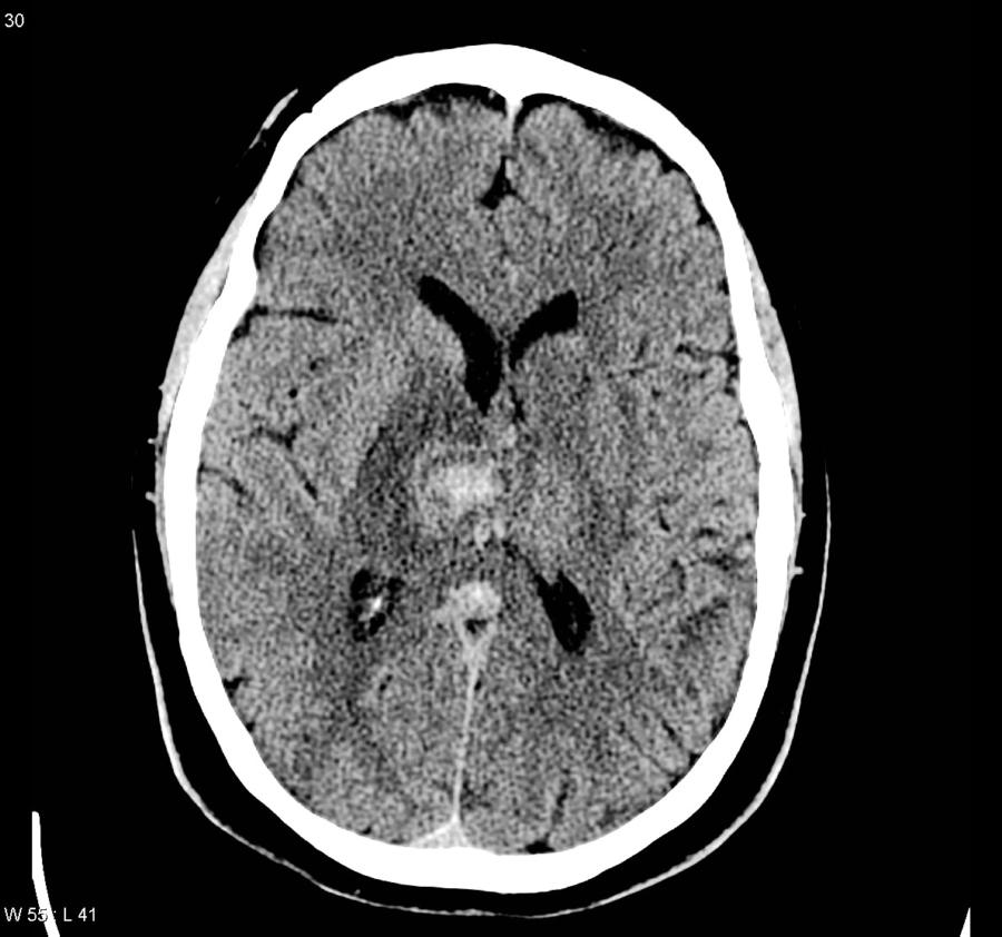 cCT nativ selber Patient zwei Tage später