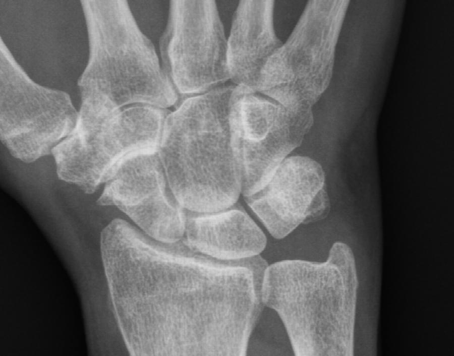 Röntgen Handwurzel rechts d.p.-Aufnahme