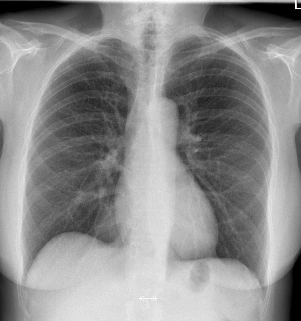 Röntgen-Thorax p.a.