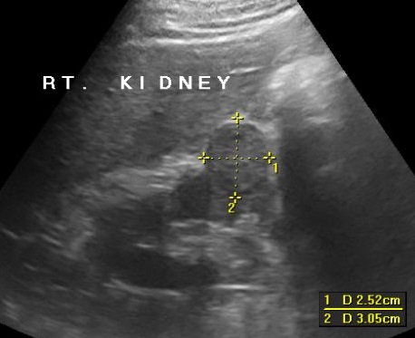 Nierentumor 3cm