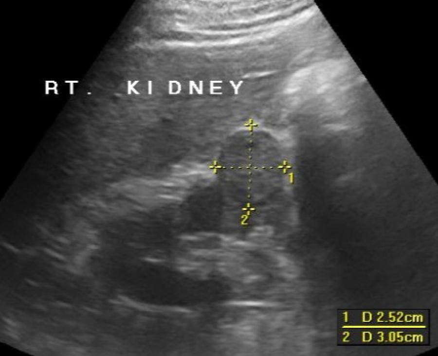 Nierentumor 3cm