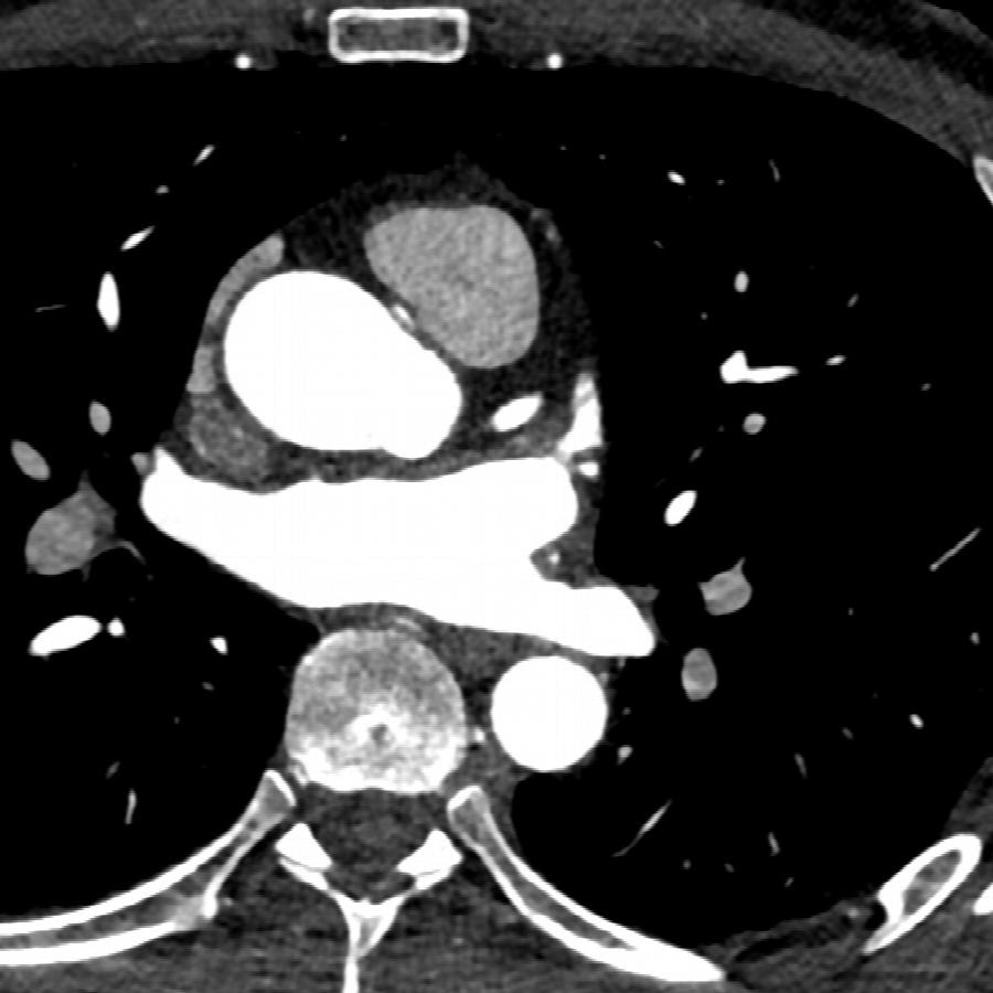 Herz-CT axial auf Höhe der Koronararterien.