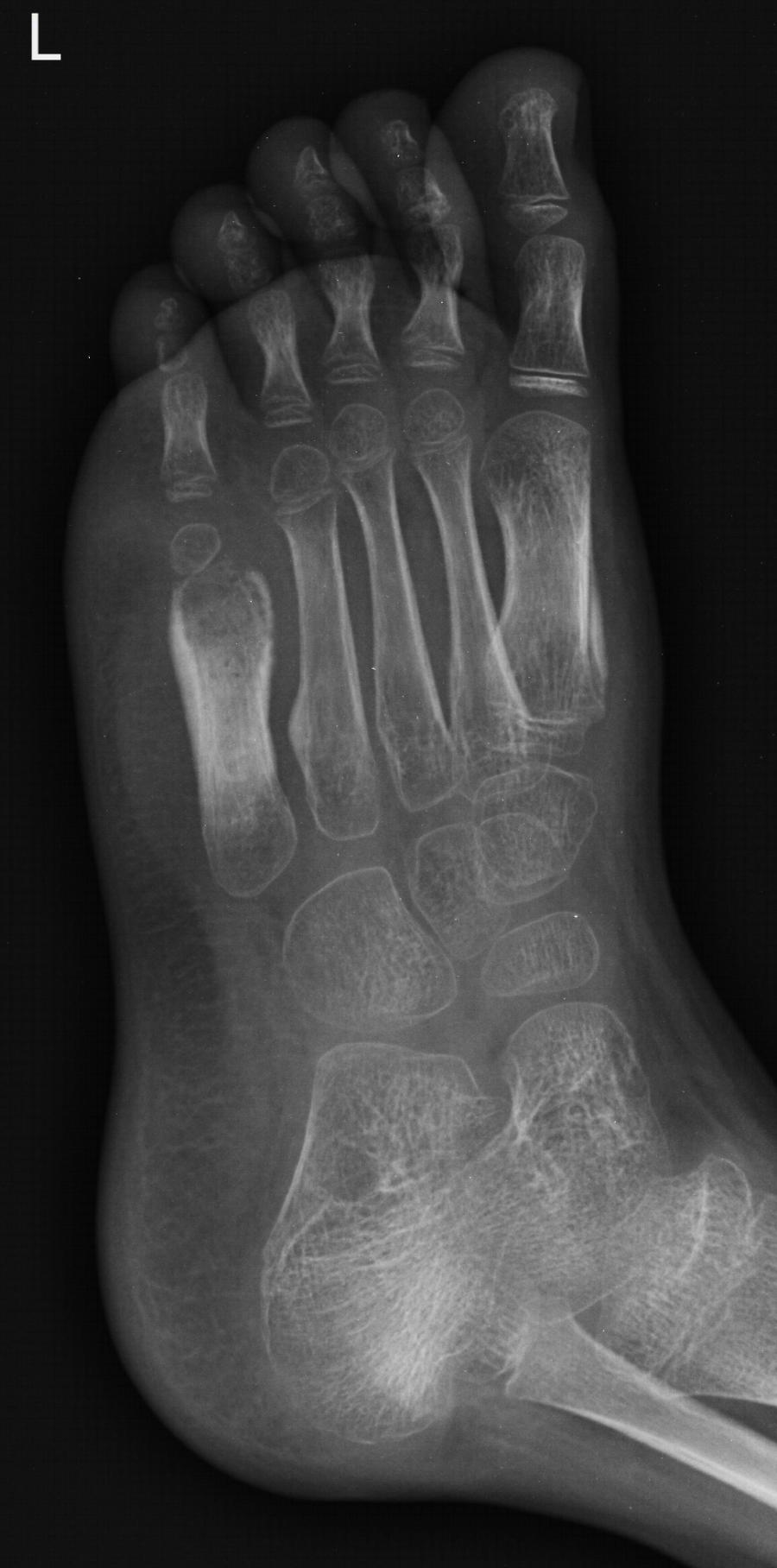 Röntgenbild rechter Fuß