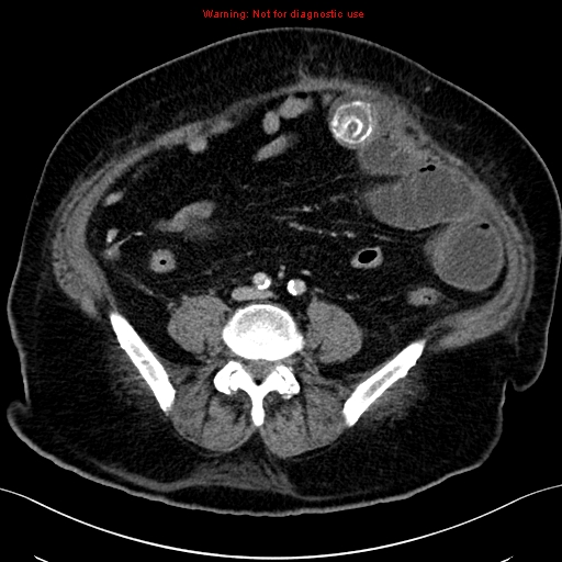 CT Abdomen venös transversal