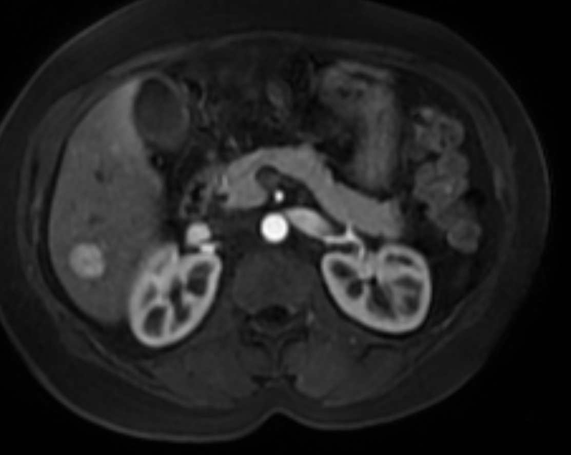 MRT axial arteriell