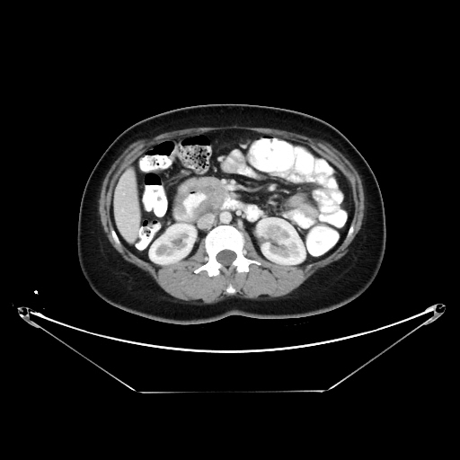 CT axial portalvenöse Phase