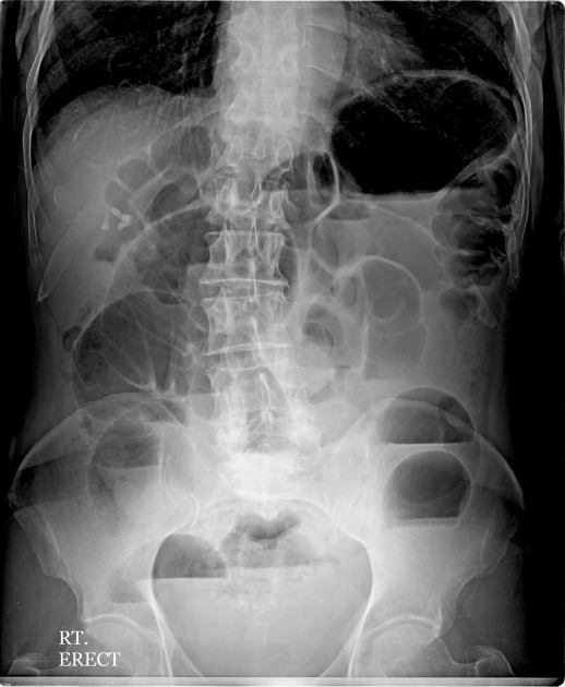 Röntgen Abdomen im Stehen