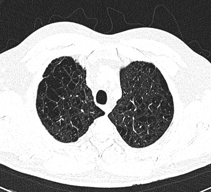 CT-Thorax nativ axial