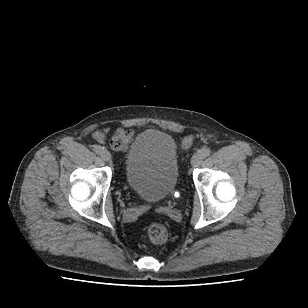 CT nativ axial