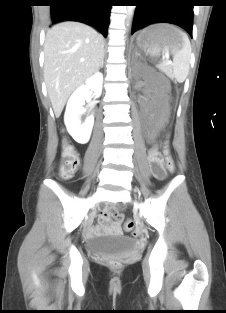 CT Polytrauma coronar