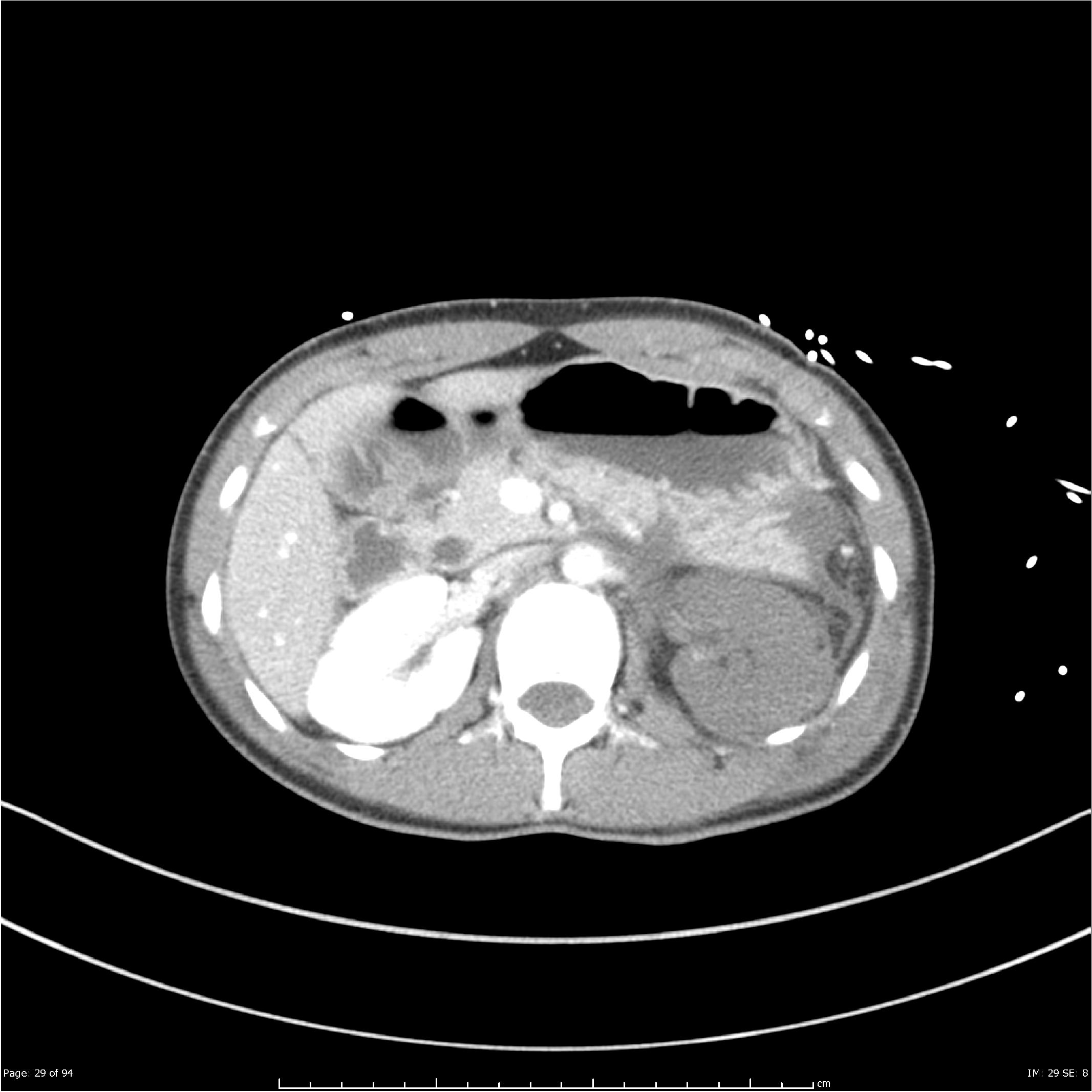 CT Polytrauma axial