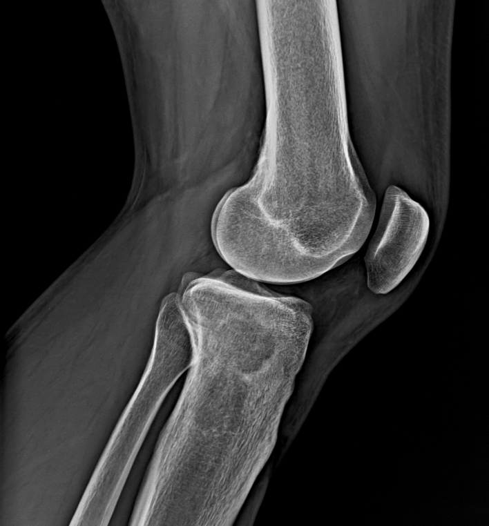 Knie lateral