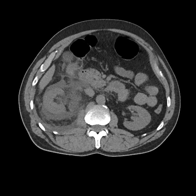 CT nativ axial