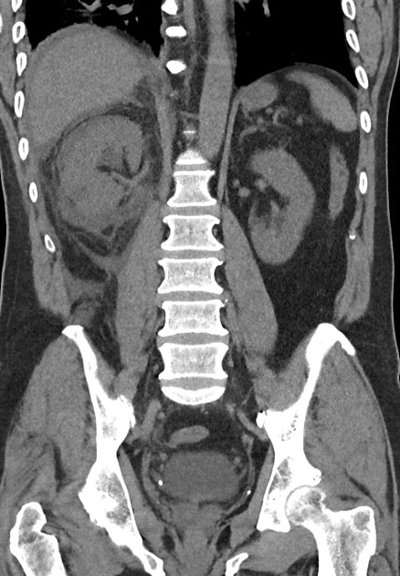 CT Abdomen nativ coronar