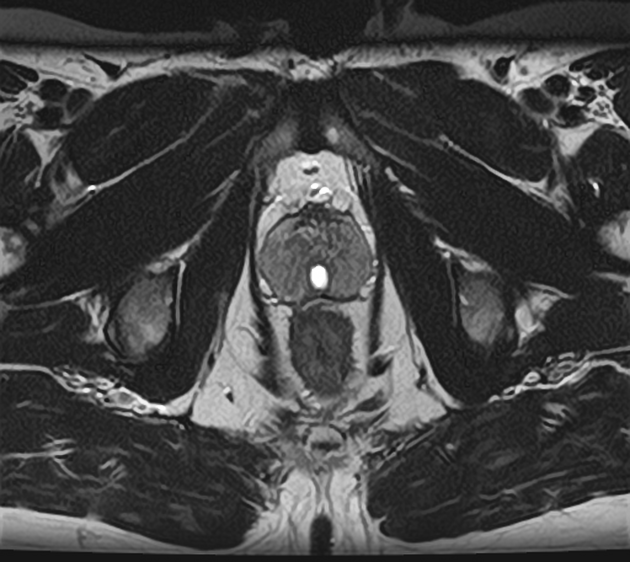 Prostata MRT T2w axial