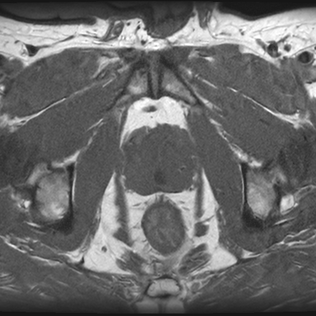 Prostata-MRT T1w axial