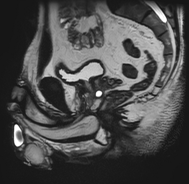 Prostata-MRT T2w sagittal