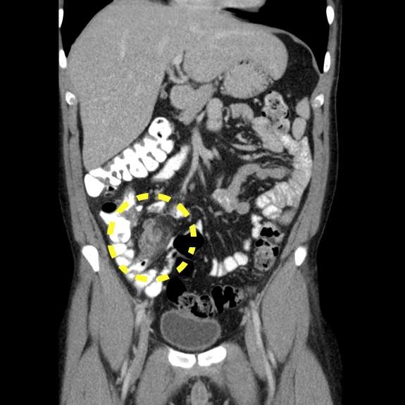 CT Abdomen pv coronar