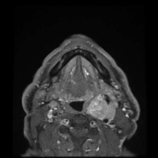 MRT axial