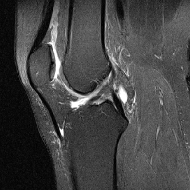 Korbhenkelriss sagittal