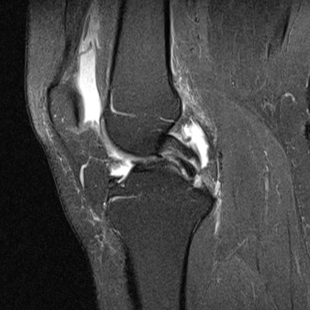 Korbhenkelriss sagittal mit double pcl sign