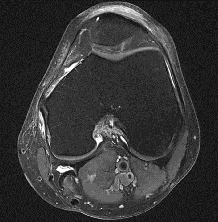 Bursitis präpatellaris axial