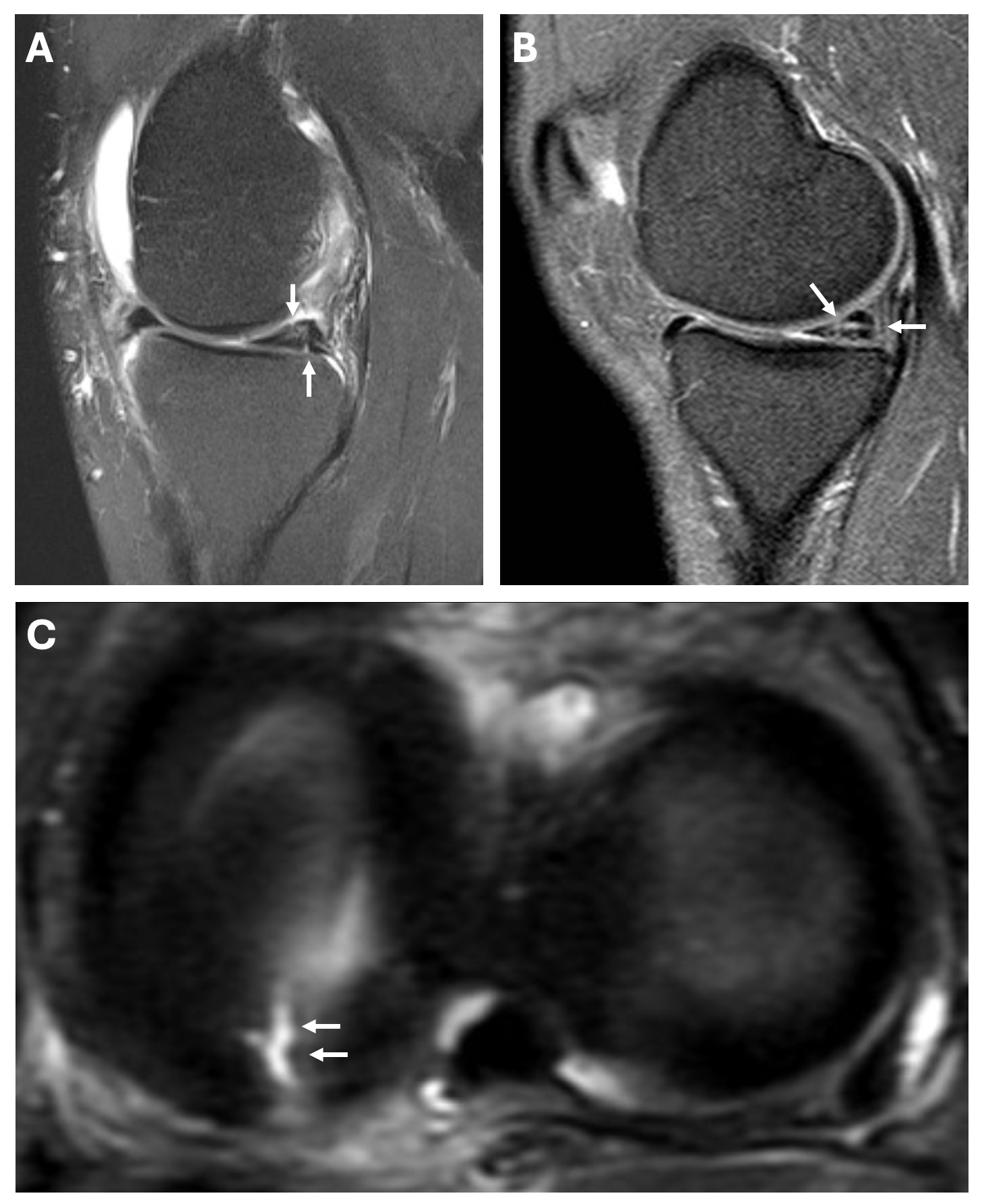 Types of meniscal tears